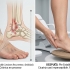 ¿Esguinces de repetición?